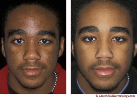 Acne laser treatment on dark skinned teenager: before & after - a photo