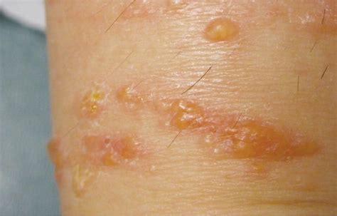 The 15 Causes Of Dyshidrotic Eczema You Should Be Aware Of Optinghealth