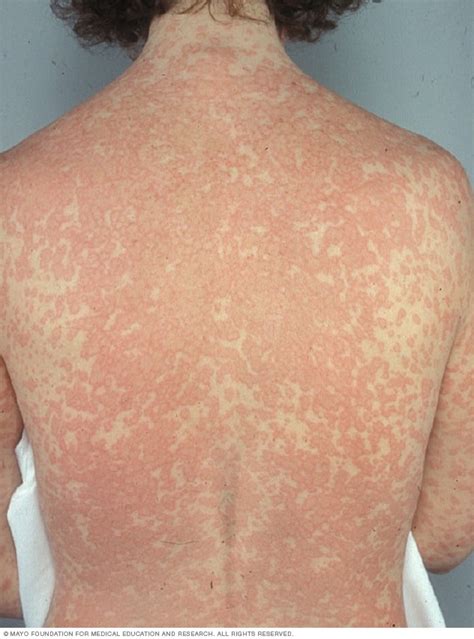 Alergia A La Penicilina Síntomas Y Causas Mayo Clinic