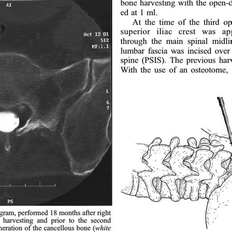 Image From A Ct Myelogram Demonstrating That The Iliac Cancellous Bone