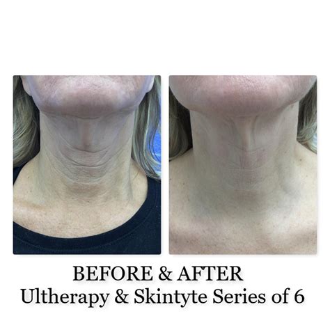 Ultherapy Bismarck Nd Pure Skin Aesthetic And Laser Center