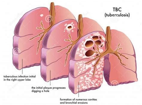Tuberculosis Condition And Treatment Airphysio