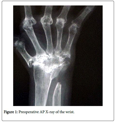 Arthritis Ap X Ray Wrist
