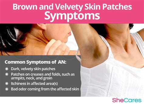 Pinpoint your symptoms and signs with medicinenet's symptom checker. Brown and Velvety Skin Patches | SheCares