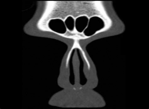 Ct Scan Of Paranasal Sinus — Coronal View Showing Normal Frontal Sinus