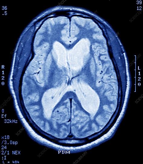 Alzheimers Disease Mri Brain Scan Stock Image C0096590 Science