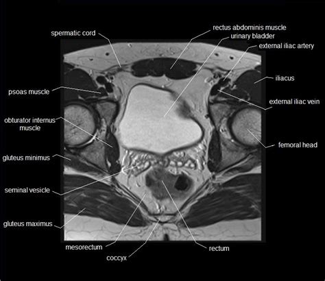 The detailed anatomy of the internal intercostal muscles is waiting. MRI pelvis anatomy | free male pelvis axial anatomy
