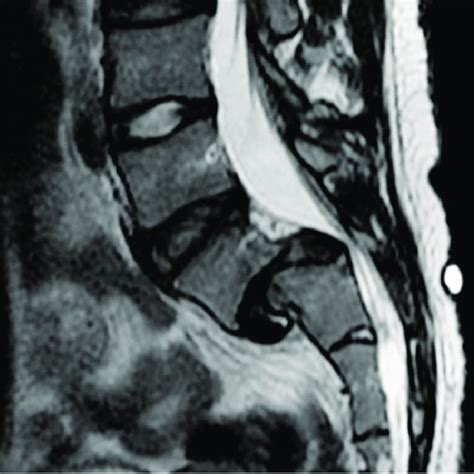 Preoperative Mri Of The Lumbar Spine Without Contrast Grade Iv