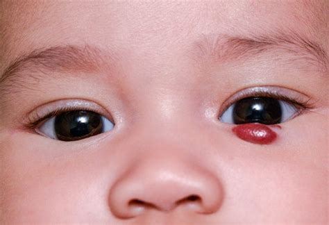 🌿 Hemangioma Infantil Causas Complicações E Tratamento