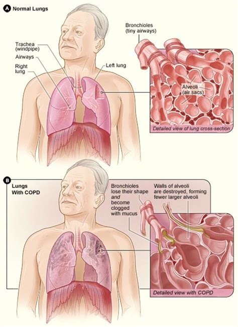 Copd Emphysema And Chronic Bronchitis Obstructive Lung Disease Youmemindbody