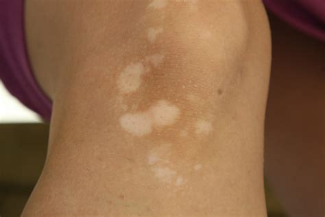 Causes Of Pityriasis Versicolor White Patches On The Skin Medsbla