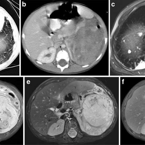 Mri In Wilms Tumor The Patient Is A 4 Year Old Boy With Left Renal