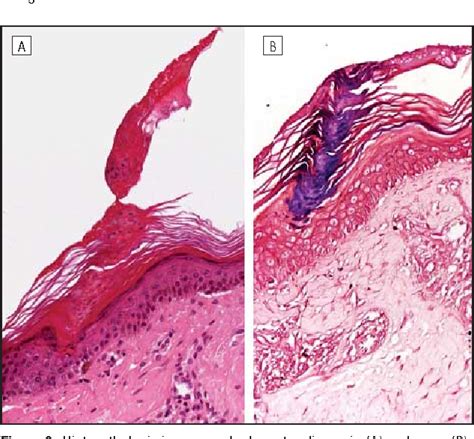 Figure 2 From Clinical And Dermoscopic Features Of Porokeratosis Of