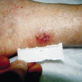 Martorell hypertensive ischemic leg ulcer: (PDF) Martorell's hypertensive leg ulcer: Case report and ...