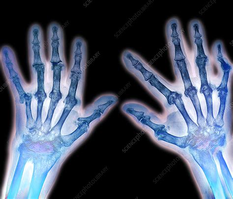 Arthritic Hands X Ray Stock Image M1100588 Science Photo Library