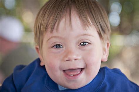 Children with down's syndrome have multiple malformations, medical conditions and cognitive impairment because of the presence of extra genetic material. Down syndrome - symptoms and treatment | Health Care ...