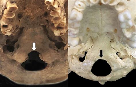 Cureus Foramen Magnum Variant With Elongation Of The Anterior Notch