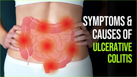 Ulcerative Colitis Truths About The Common Inflammatory Disorder