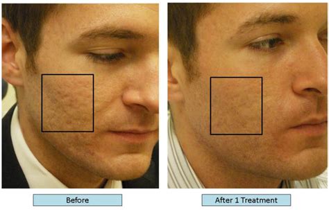 Dr Richard Balikian Now Can Treat Acne Scars With Lasers