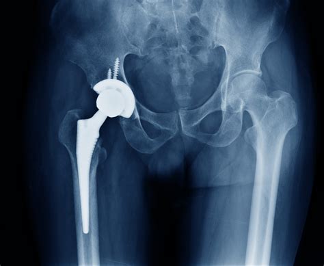 What Is My Hip Replacement Made Of Grosvenor Orthopaedic Partners