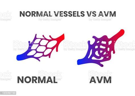 Normal Vessels And Arteriovenous Malformation Stock Illustration