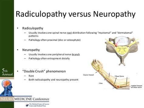 Radiculopathy Vs Peripheral Neuropathy