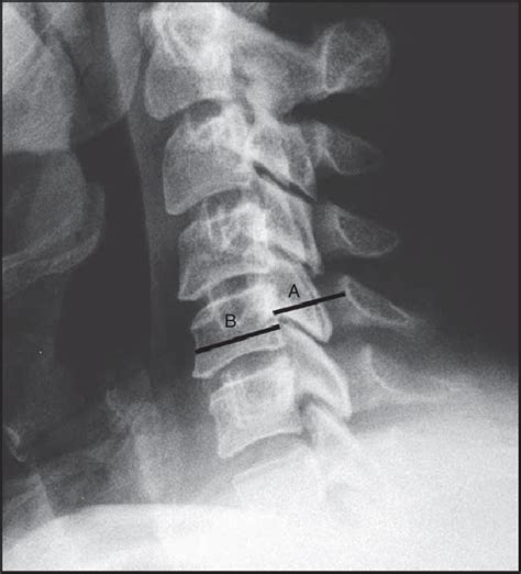 A Lateral Cervical Spine Radiograph Depicting The Measurements For