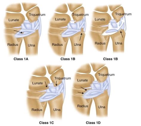 Ulnar Grinding Test Triangular Fibrocartilage Complex Tfcc