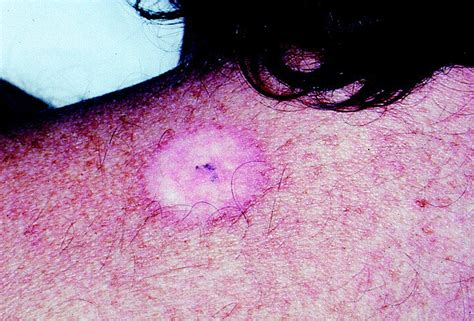 Histologic Cure Of Basal Cell Carcinoma Treated With Cryosurgery