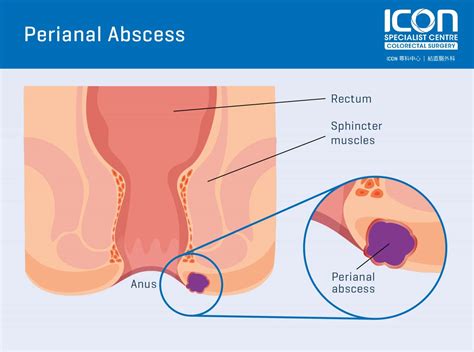 Perianal Abscess Icon Specialist Centre