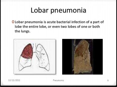 Multilobar pneumonia refers to the involvement of multiple lobes in a single lung or both lungs. Pneumonia Diagnosis and treatment