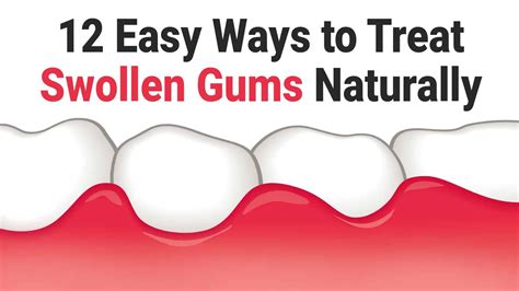 12 Quick Remedies For Treating Swollen Gums Swollen Gum Swollen Gums