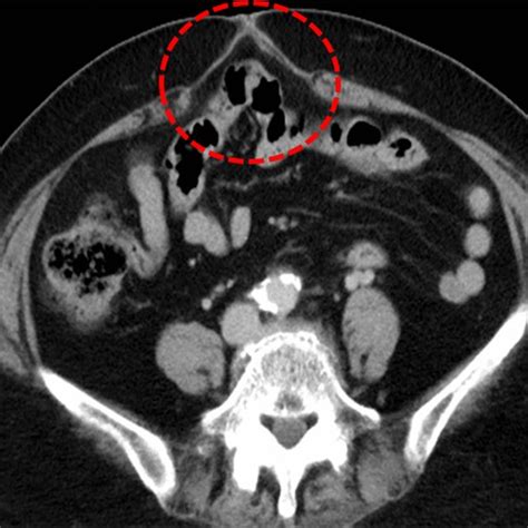 The Computed Tomography Diagnosis Of Incisional Hernia Incisional