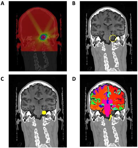 Cognitive And Neuroimaging Outcomes In Individuals With Benign And Low