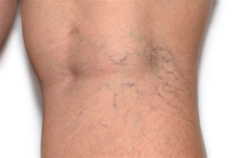 Are Varicose Veins Genetic Fox Vein And Laser Experts