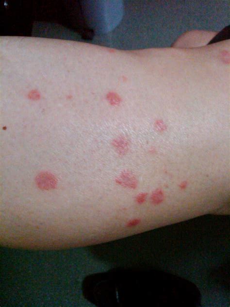 Small Red Spots On Skin Not Itchy Tiny Dots Bumps Pinpointed Rezfoods