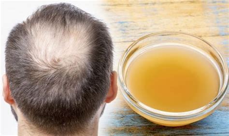 Apple cider vinegar also contains nutrients (vitamins b, c, and potassium). Hair loss treatment: Apple cider vinegar could increase ...