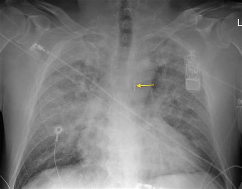 Intra-aortic balloon pump - Radiology at St. Vincent's University Hospital