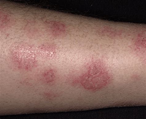 Red Bumps On Legs That Itch At Night Boskw
