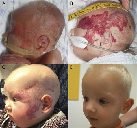 PHACE syndrome in a preterm infant | Neurology