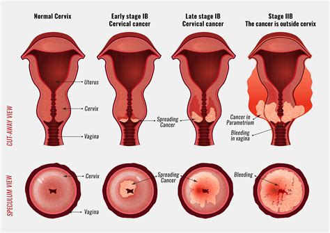 Cervical Cancer What You Should Know Rebiz Zield