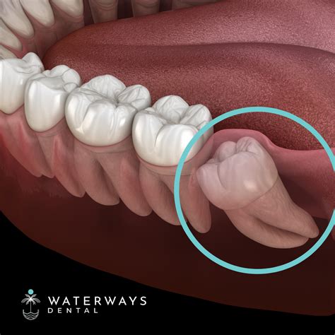 What To Know About Wisdom Teeth Removal Waterways Dental