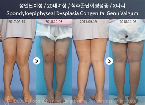 Congenital Patients Knock Knee Correction Limb Lengthening And Complex