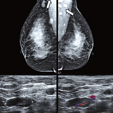 Pdf Abnormal Axillary Lymph Nodes On Negative Mammograms Causes