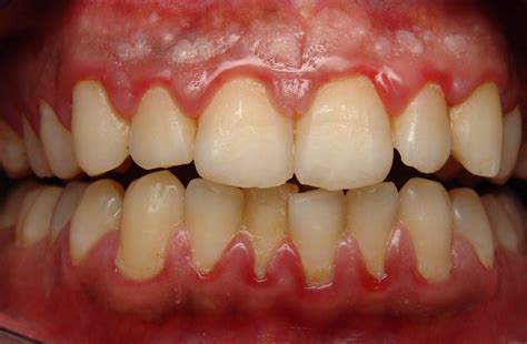 Knowing What To Do If You Have Recurring Swollen Gums Canyon Gate Dental Of Orem