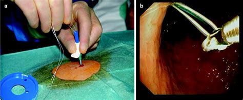 Percutaneous Endoscopic Gastrostomy Peg Tube Placement