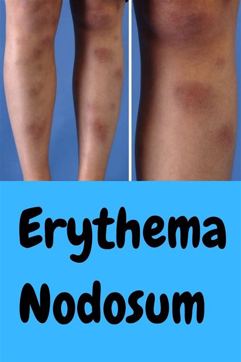 Erythema Nodosum Erythema Nodosum Health Knowledge Skin Cure