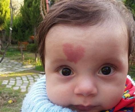 A Baby Born With A Heart Shaped Birthmark Became Famous In 2015 This