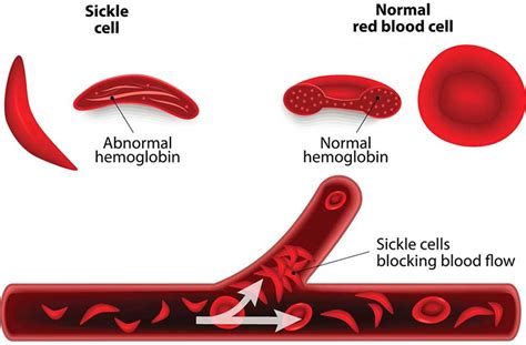 Sickle Cell Disease1 Exploring Biology