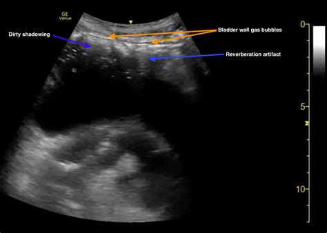 Cureus Point Of Care Ultrasound Diagnosis Of Pneumoperitoneum In The